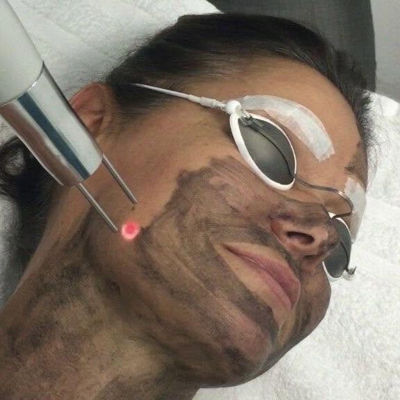 Carbon laser facial treatment at Dingwall Laser Clinic