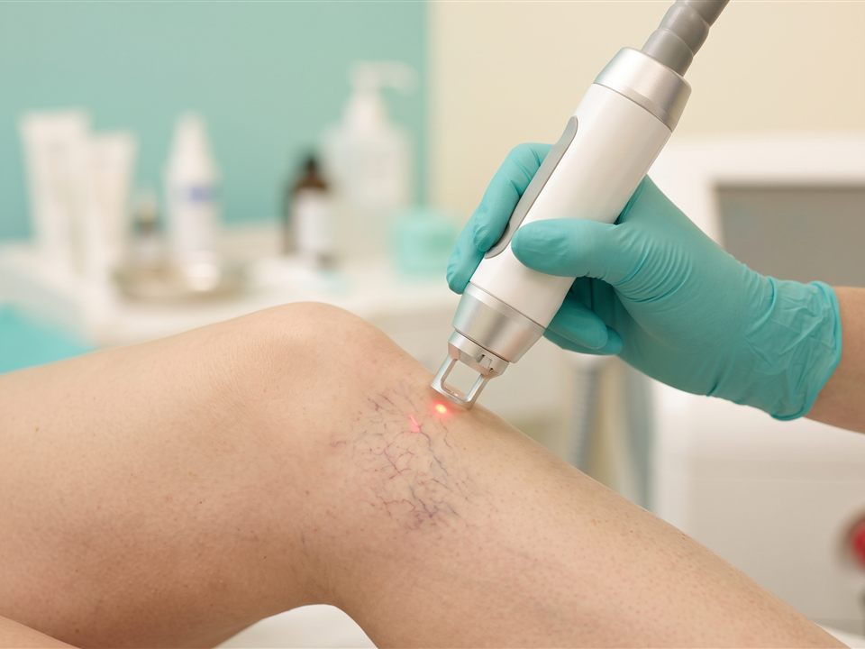 Thread vein removal